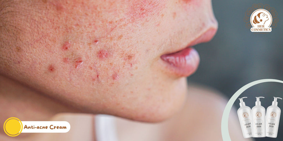 Come sbarazzarsi dell'acne sul viso?
