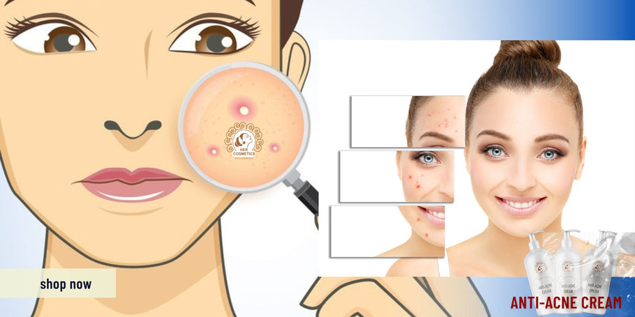 Salva la tua pelle: consigli per eliminare l'acne